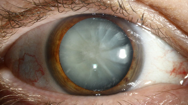Cirurgia de Catarata